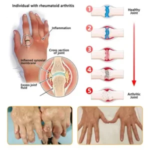 Bee Venom Pain-Relief Bone Healing Spray