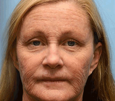 Botox Bee Venom Wrinkle Removal Cream