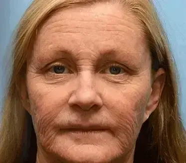 Botox Bee Venom Wrinkle Remover Cream