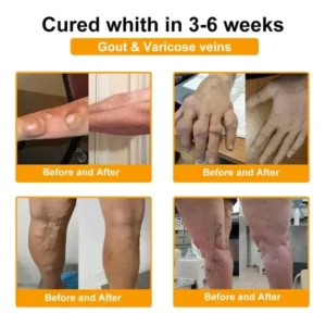 Botulinum Toxin & Bee Venom Pain-Relief Bone Healing Cream