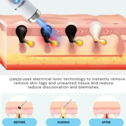 Non-Invasive Mole and Wart Removal Laser Pen