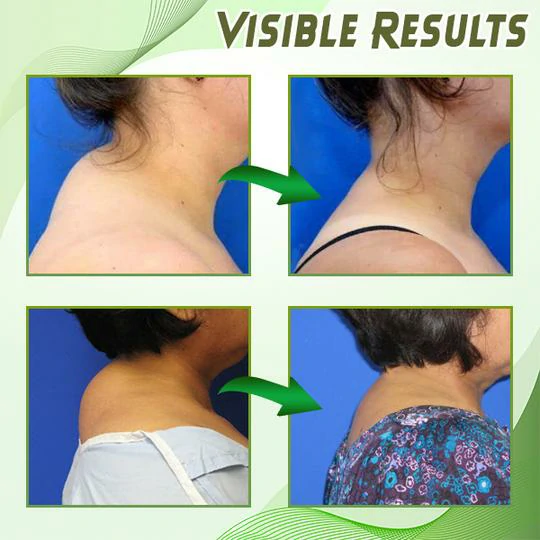 Dowager's Hump Neck Drain Patch - Image 8