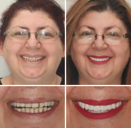 Advanced Customized Full Denture Set - Image 7