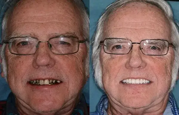 Advanced Customized Full Denture Set - Image 9