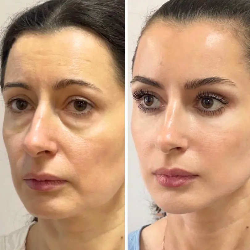 LiftRenew All-in-One Under-Eye Stick - Image 2