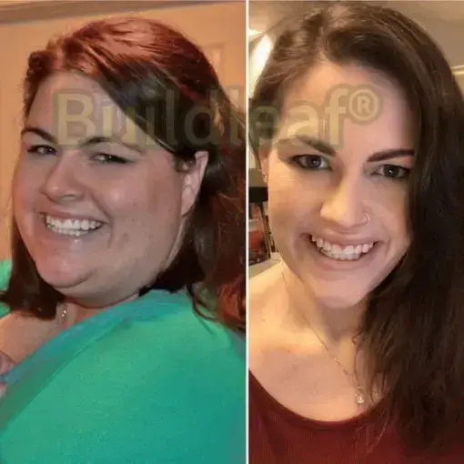 SMGT Nano Microneedle Patch with Collagen Peptides &Matrixyl 3000 - Image 9