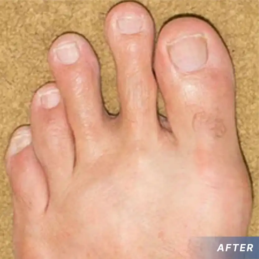 GoutEase Relief Spray - Image 12