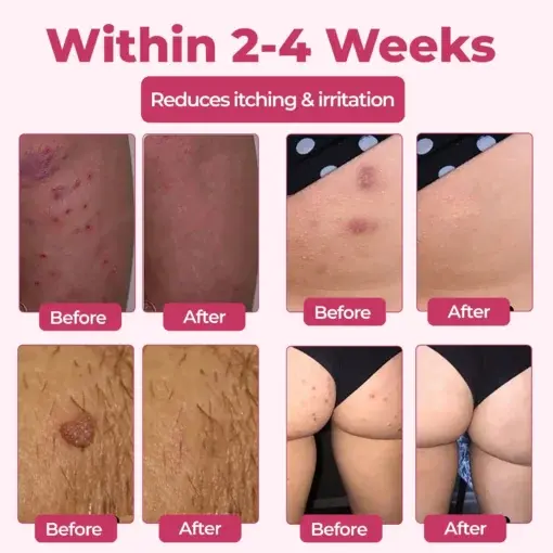 Woman’s Genital HPV Relief Cream - Image 3