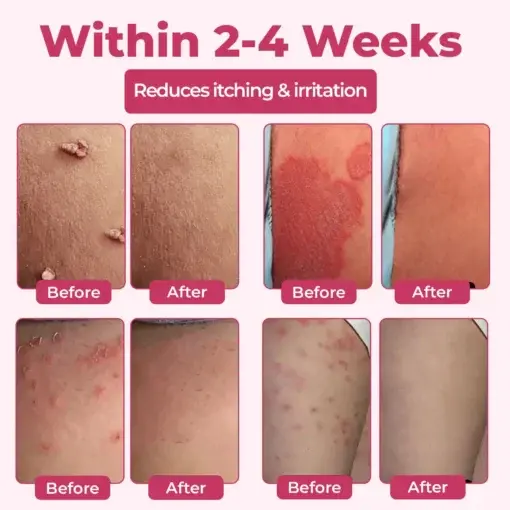 Woman’s Genital HPV Relief Cream - Image 4