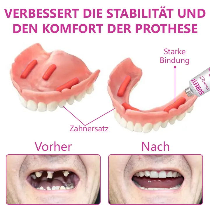 Thermischer Prothesenkleber - Image 2