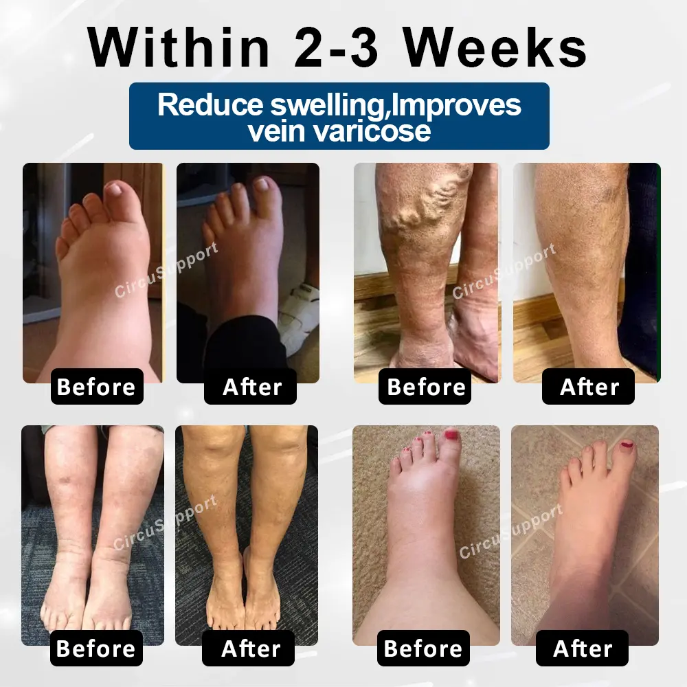 Magnetic EdemaCare Insoles - Image 2