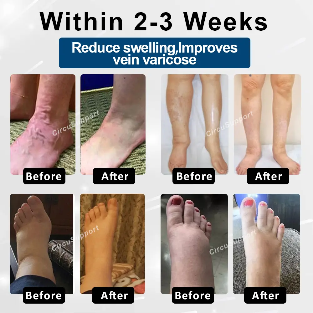 Magnetic EdemaCare Insoles - Image 3