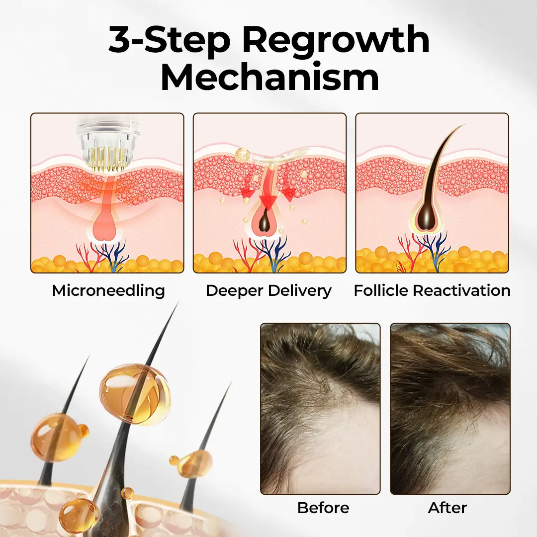 FollicleBoost Micro-Delivery System Advanced Scalp Renewal Kit - Image 2