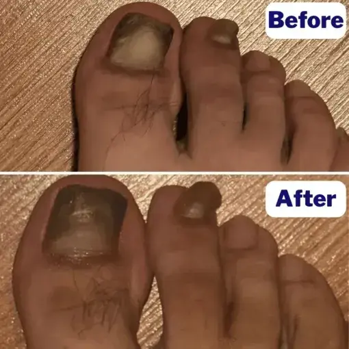 Fungal Nail Patches - Image 2