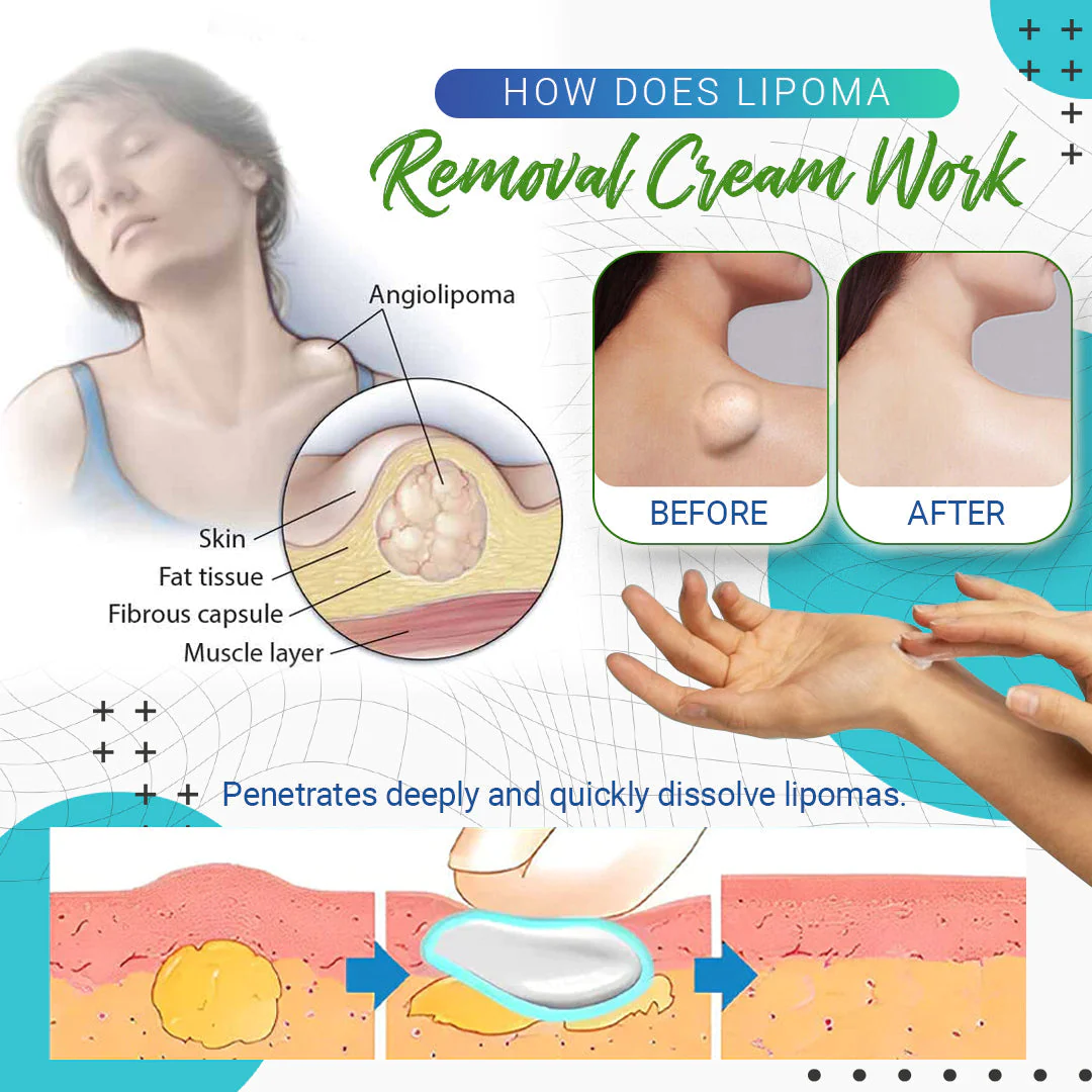 Cvreoz Lipoma Removal Cream - Image 4
