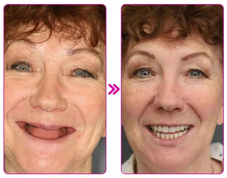 Thermoplastic Denture Adhesive - Image 7