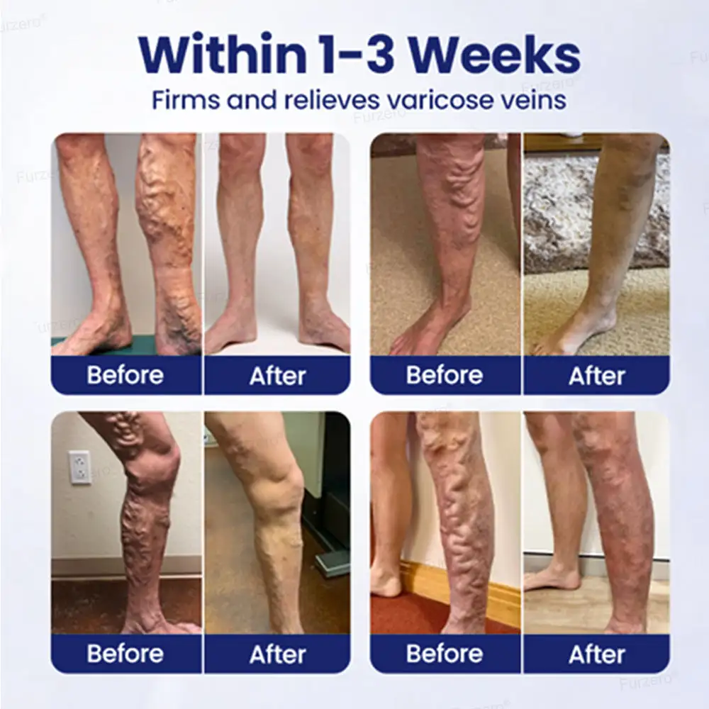 VeinFreedom Herbal Spray - MicroMist Therapy - Image 3