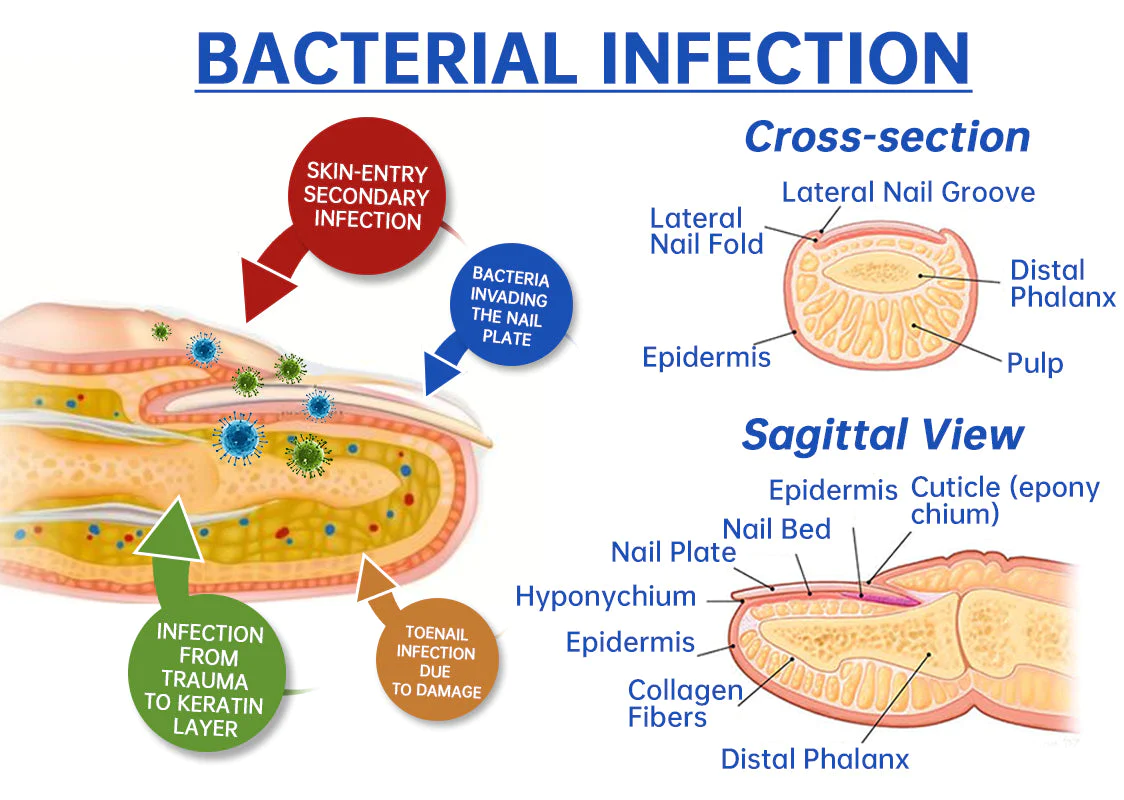 PureNail Fungus Laser Therapy Device - Image 3