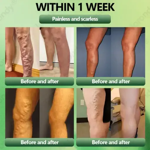 Horse Chestnut Vein Cream - Image 3