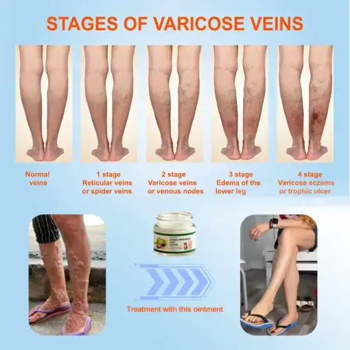 Horse Chestnut Vein Cream - Image 7