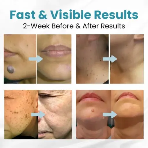 Non-Invasive Mole and Wart Removal Laser Pen - Image 2