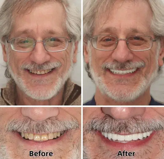 Advanced Custom-Fit Functional Dentures - Image 4