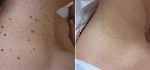 Bee Venom Mole and Wart Treatment Cream - Image 8