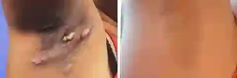 Bee Venom Mole and Wart Treatment Cream - Image 9