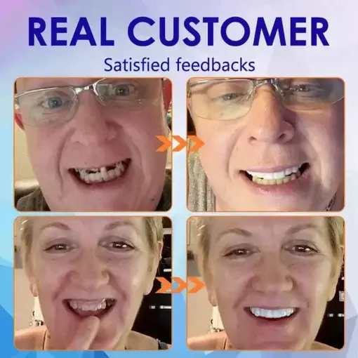 Advanced Customized Full Denture Set - Image 11