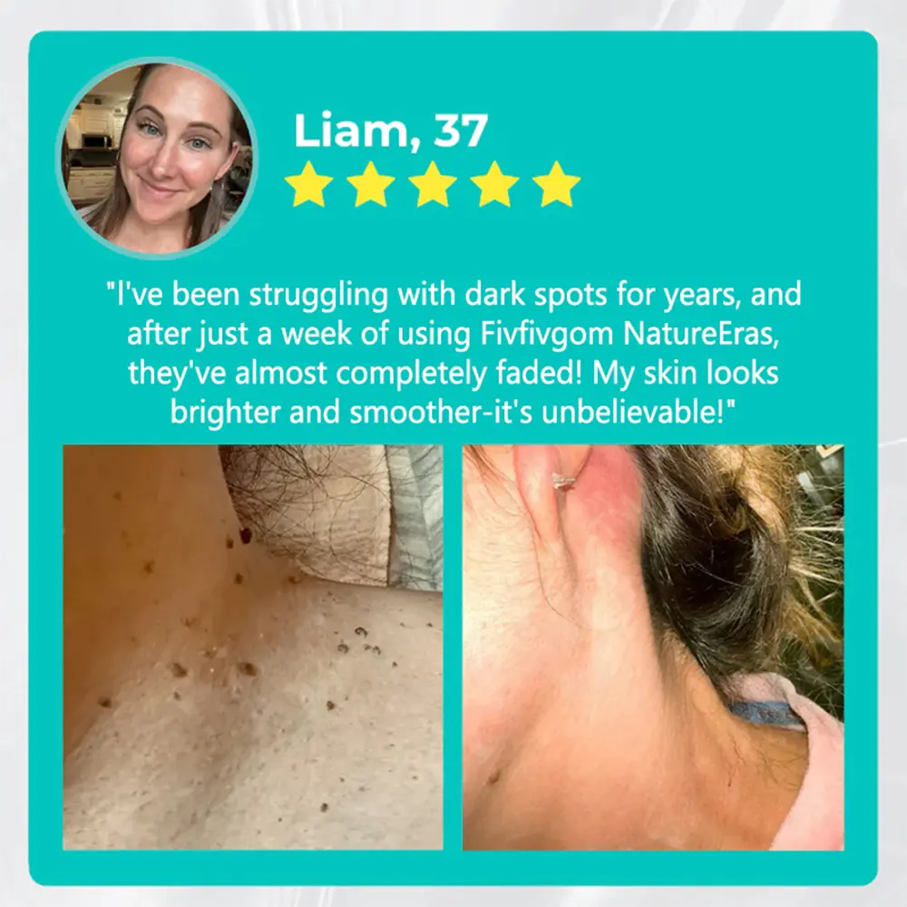 NatureErase Instant Mole & Spot Removal Gel - Image 6