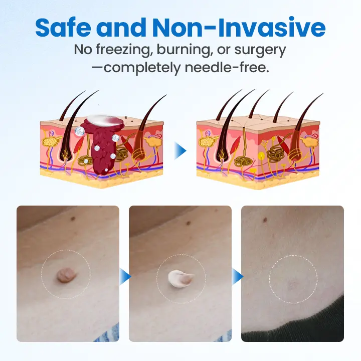 TagGone Wart Removal Cream - Image 4