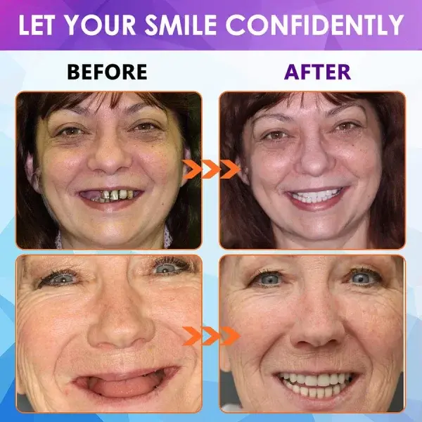 Advanced Customized Full Denture Set - Image 10