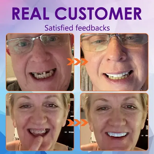 Advanced Customized Full Denture Set - Image 11