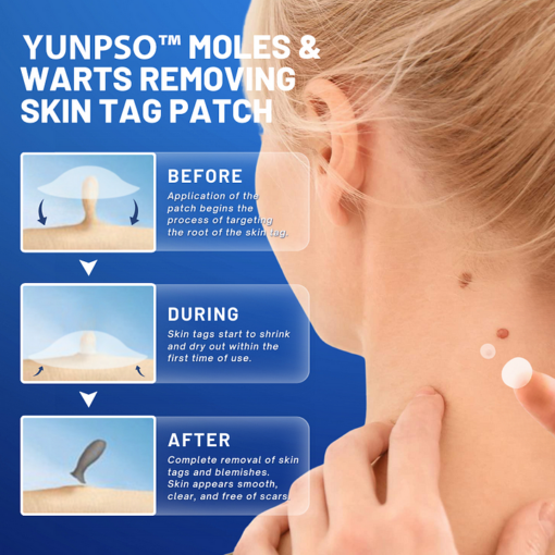 Moles & Warts Removing Skin Tag Patch - Image 3