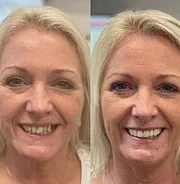 Advanced Custom-Fit Functional Dentures - Image 3