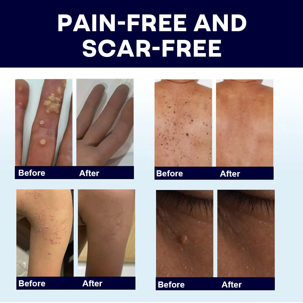 WartLock CRYO RECOVERY SPRAY - Image 2