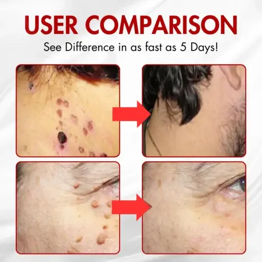 Nano-Microdart Skin Tag & Spot Corrector Patches - Image 2