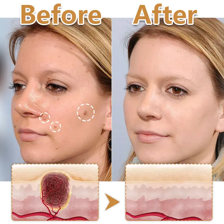 BeeVenom Wart Drop Serum - Image 4