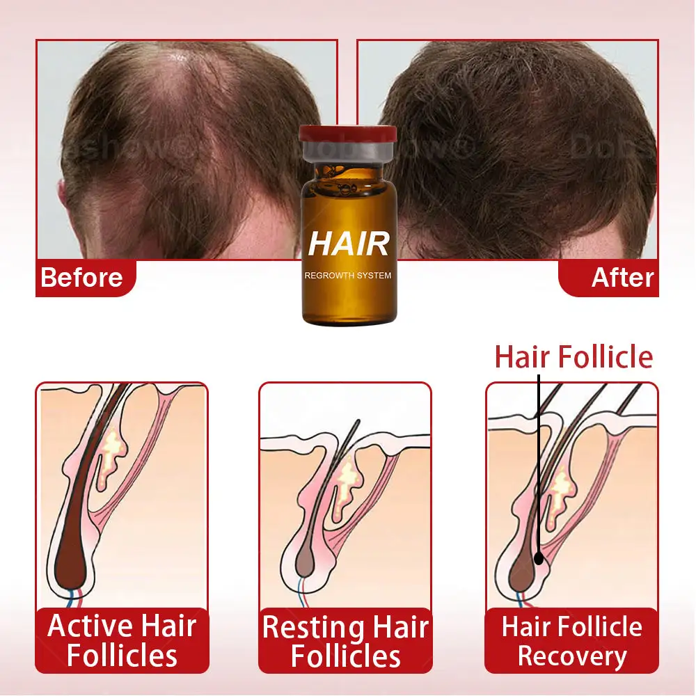 Hair Regrowth System - Image 6