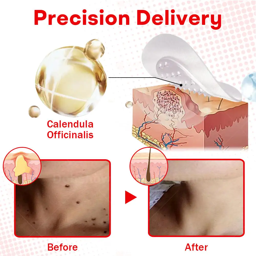 MicroNeedle BotanicSkin Tag Removal Patch - Image 6