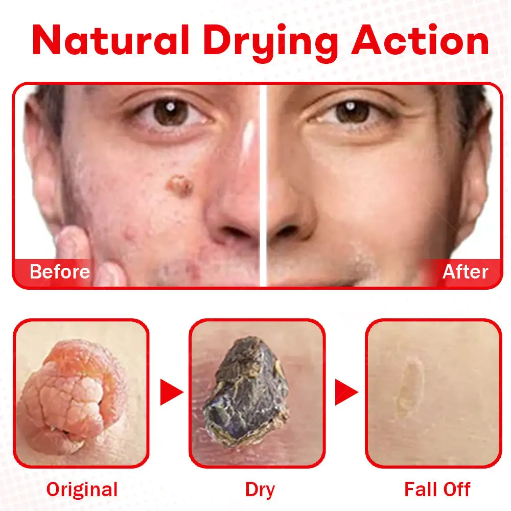 MicroNeedle BotanicSkin Tag Removal Patch - Image 8