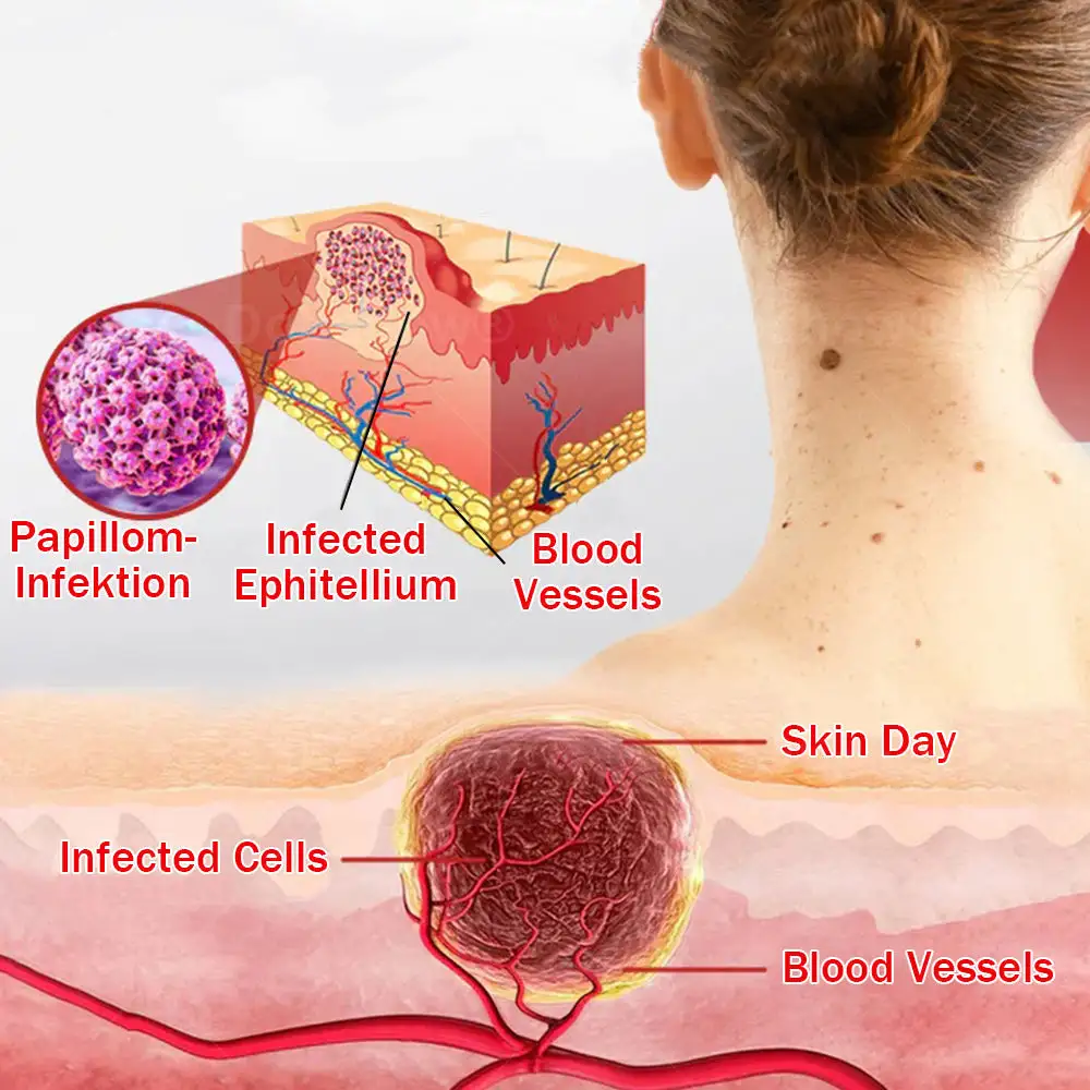 MicroNeedle BotanicSkin Tag Removal Patch - Image 9