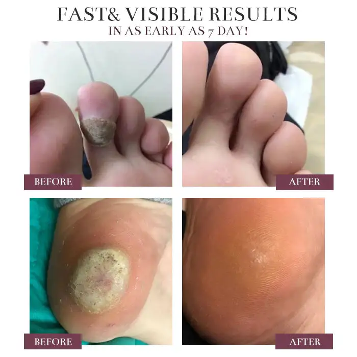 BlackRice Nano Clear Wart Repair Cream - Image 4