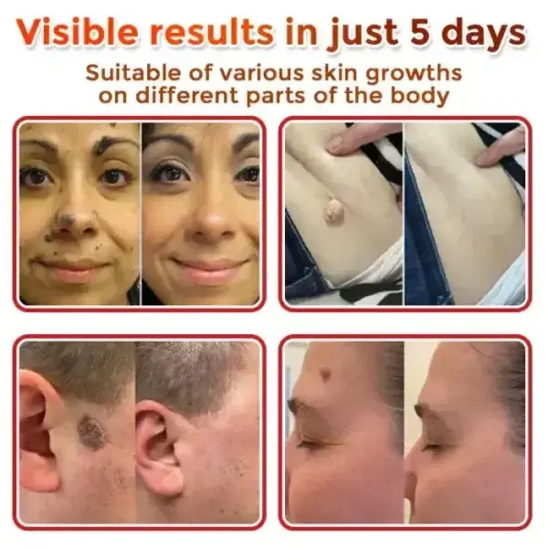 Removal Patch: Gentle Microneedle Patches for Skin Tag & Mole Removal - Image 3