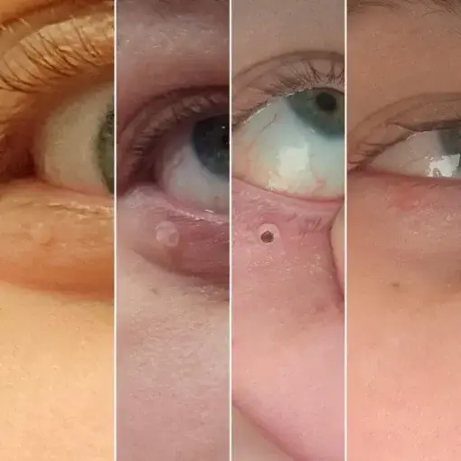 – Skin Wart & Skin Tag Removal Kit - Image 2