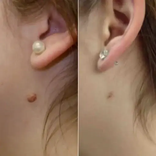 – Skin Wart & Skin Tag Removal Kit - Image 3