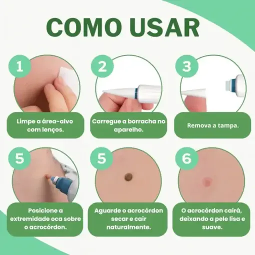 – Skin Wart & Skin Tag Removal Kit - Image 4