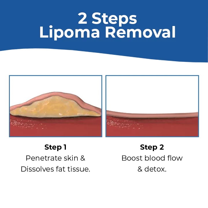 Lipoma Removal Cream - Image 4