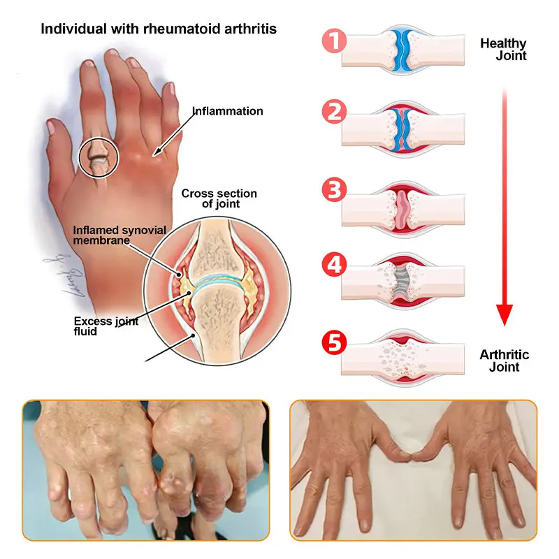 BEE VENOM LITHOSPERMUM Pain-Relief Bone Healing Cream - Image 13