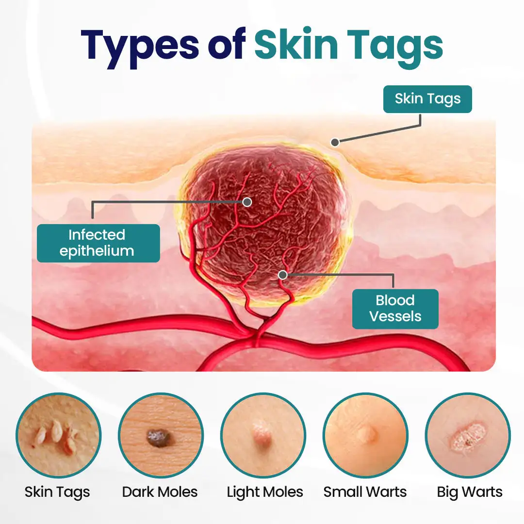 WartLift Corn Removal Liquid - Image 3